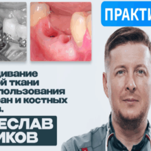 Вячеслав Куликов – Наращивание костной ткани
