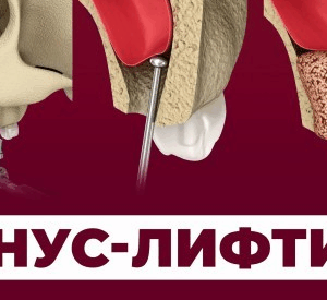 Мишель Джакотти, Паскаль Валентайн – Синус-лифтинг